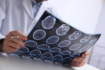 Umjetna inteligencija mogla bi donijeti revolucionarni napredak kod oboljelih od Alzheimera